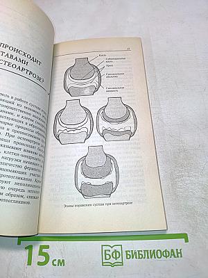 Артроз: Все способы лечения и профилактики