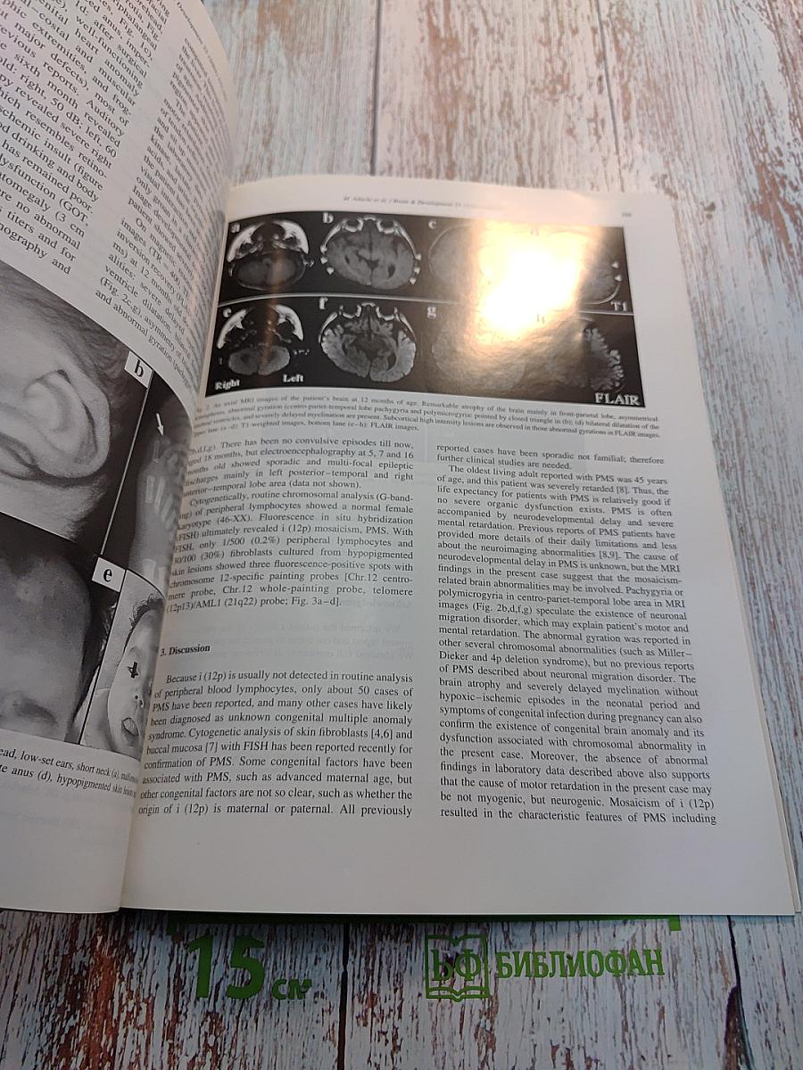 Brain & Development, Vol. 25 No. 5, August 2003