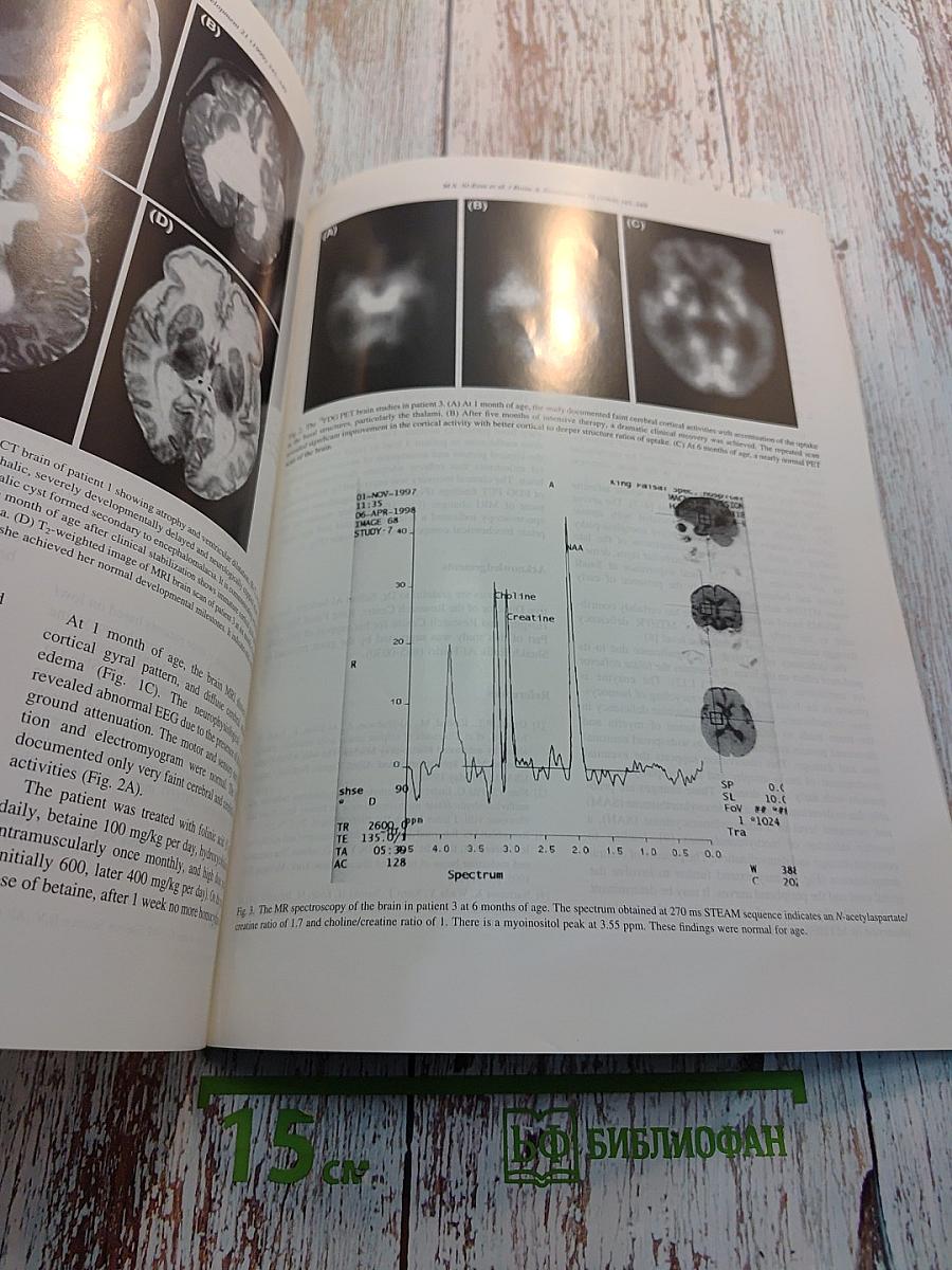 Brain & Development, Vol. 21 No. 5
