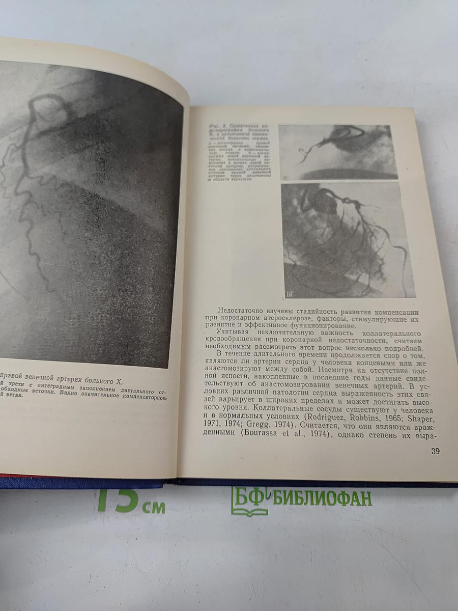 Реабилитация больных ишемической болезнью сердца