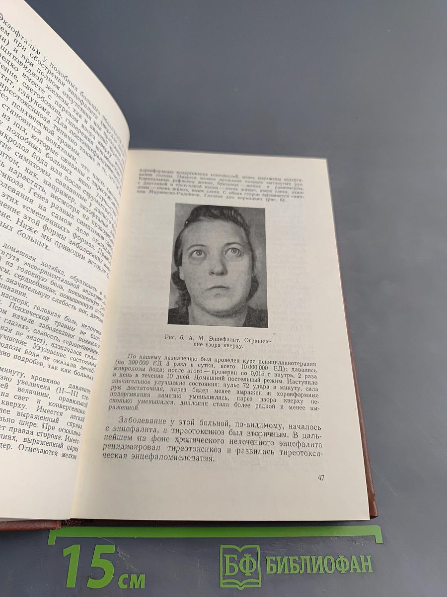 Неврологический анализ тиреотоксикоза