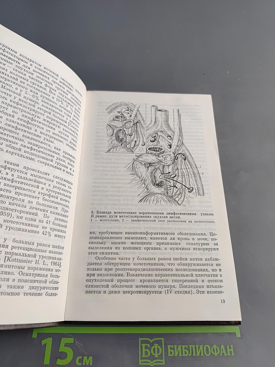 Урологические осложнения при лечении онкологических заболеваний органов таза