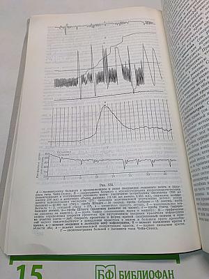 Церебральные кризы и инсульт