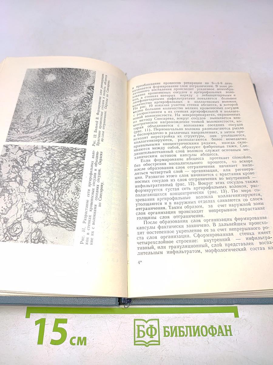 Метастатические абсцессы головного мозга
