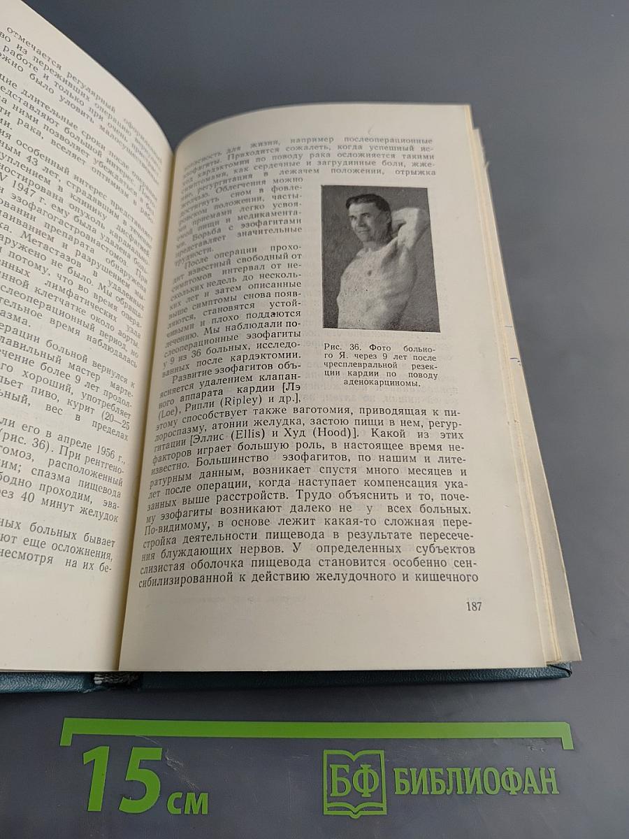 Рак кардиального отдела желудка