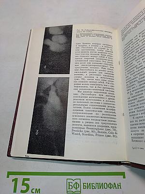 Гидронефротическая трансформация