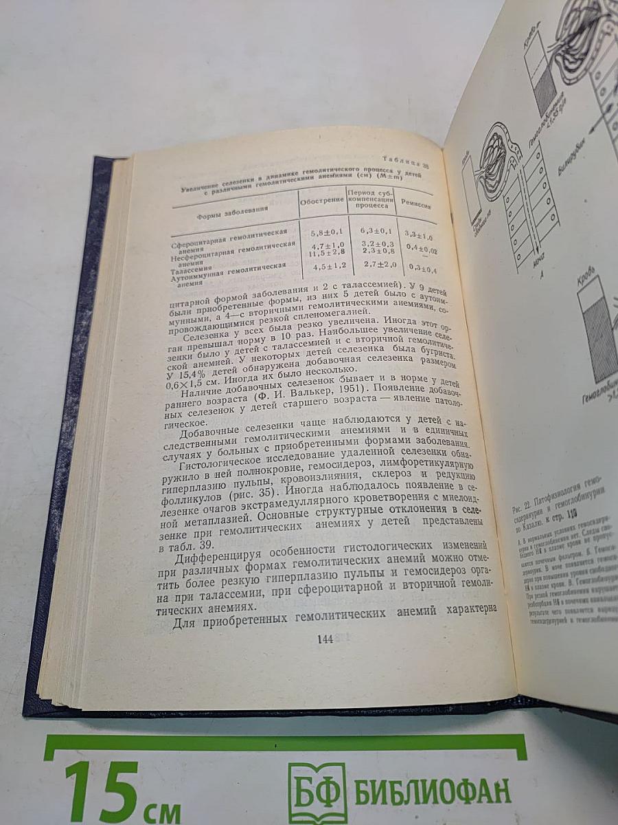 Гемолитические анемии у детей