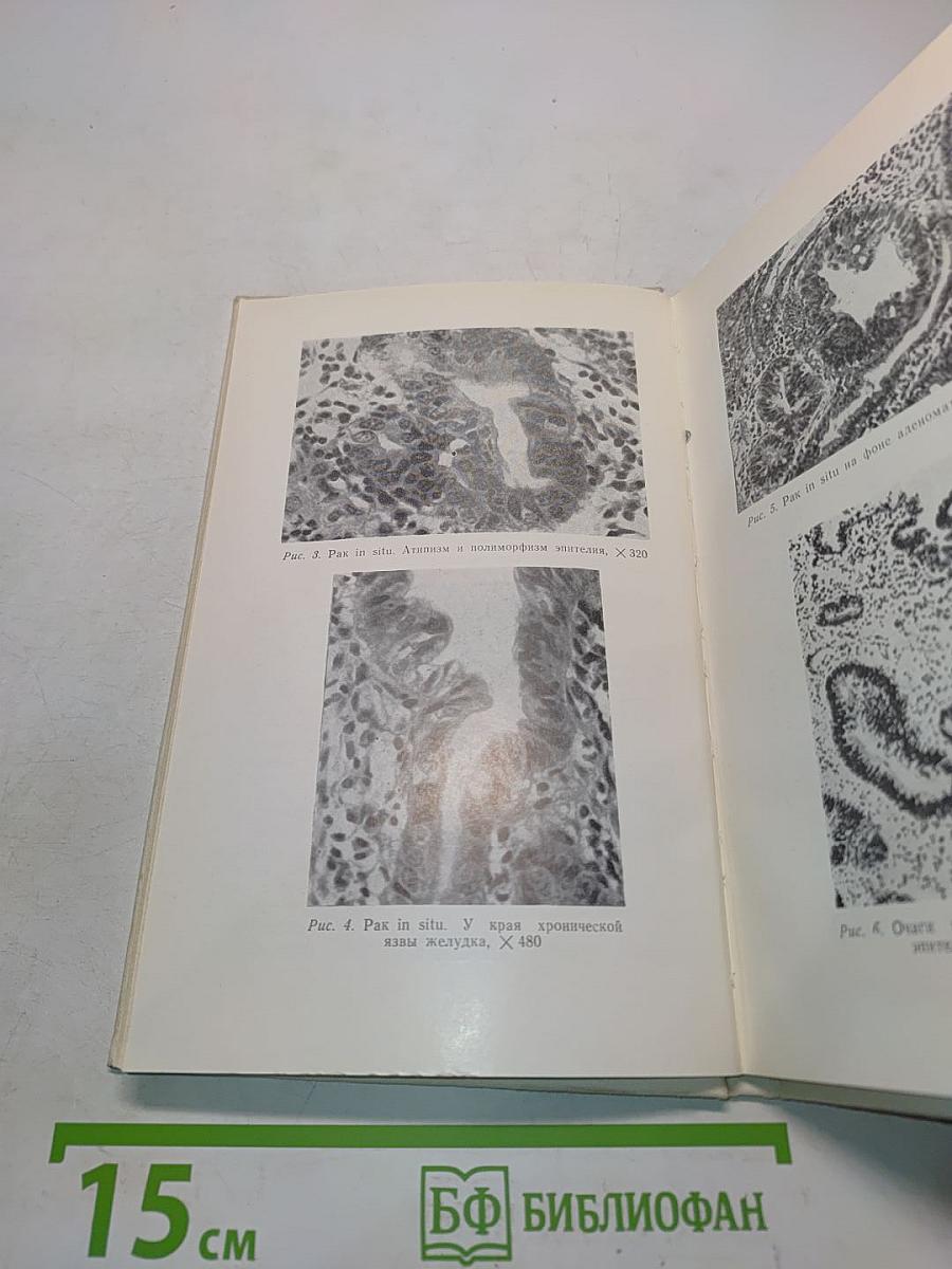 Клиническая и диагностика раннего рака желудка