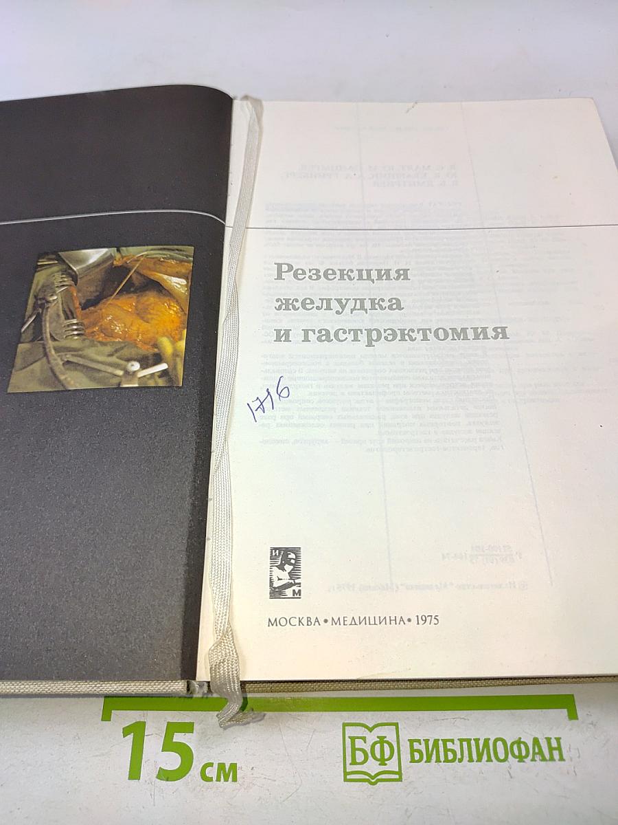 Резекция желудка и гастрэктомия