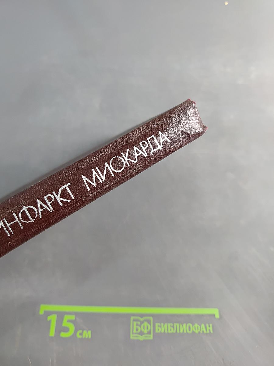 Инфаркт миокарда