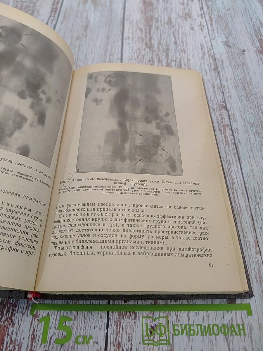Клиническая лимфография