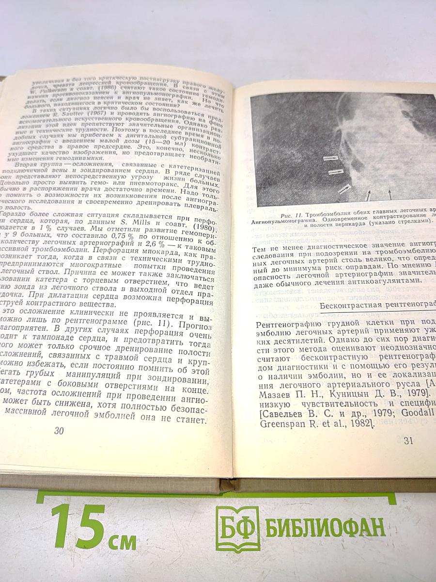 Массивная эмболия легочных артерий