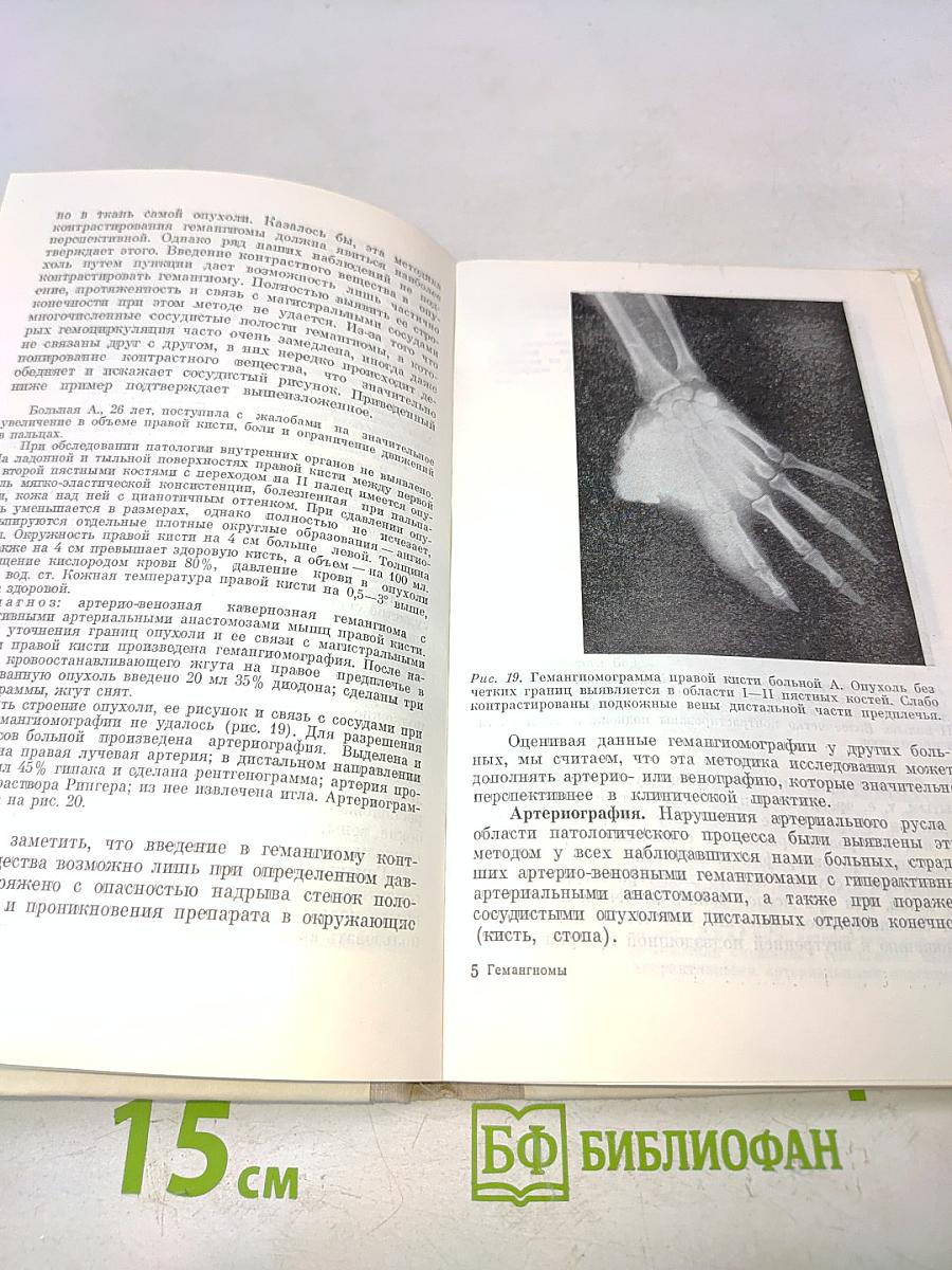 Гемагиомы (Диагностика и лечение)