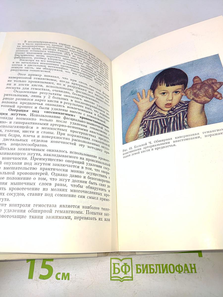 Гемагиомы (Диагностика и лечение)