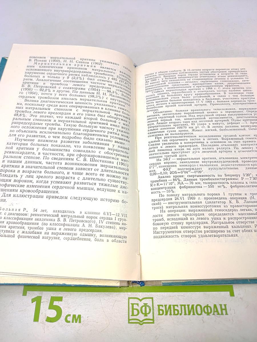 Хирургическое лечение ревматического митрального стеноза, осложненного внутрипредсердным тромбозом