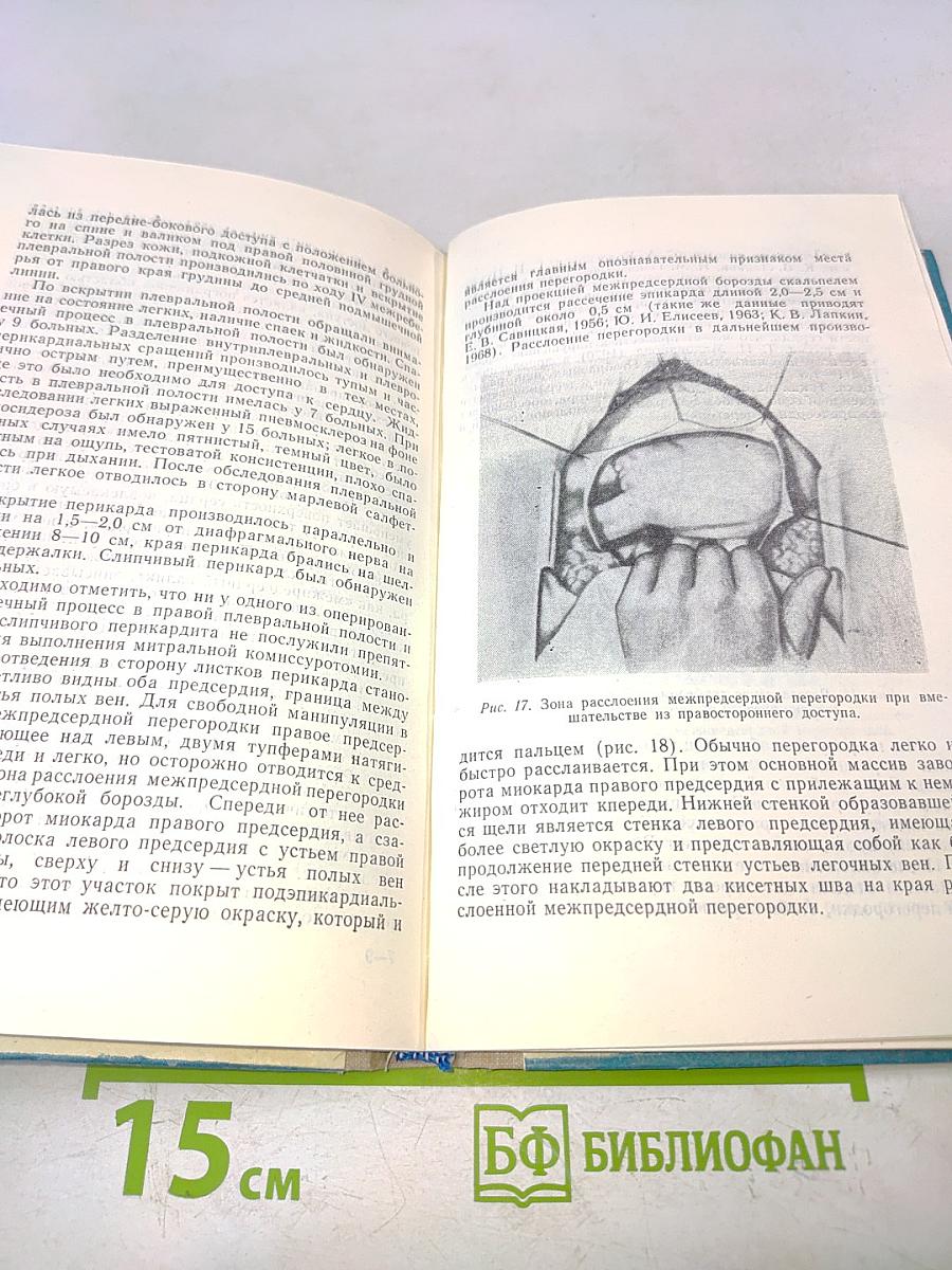Хирургическое лечение ревматического митрального стеноза, осложненного внутрипредсердным тромбозом