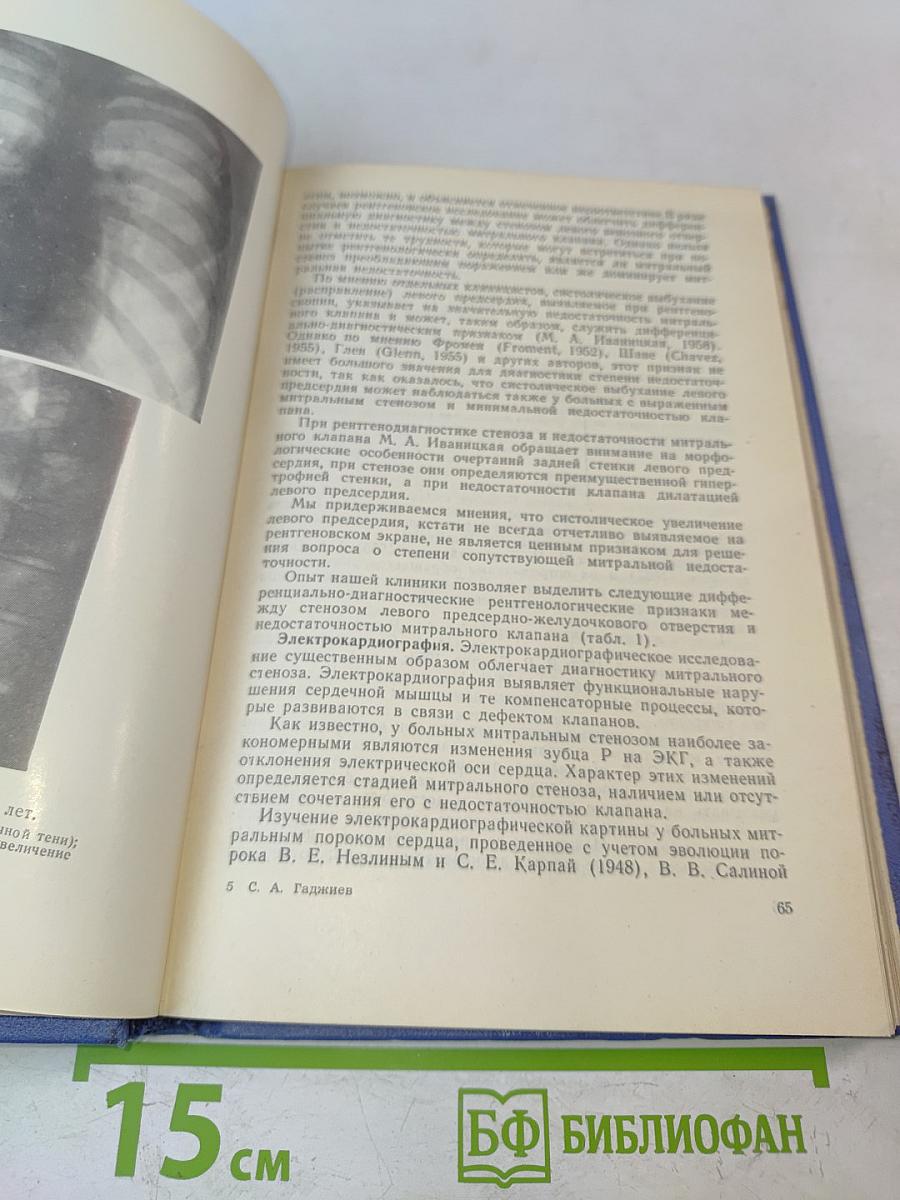 Хирургическое лечение митрального стеноза