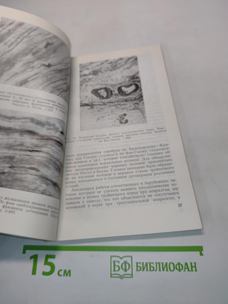 Невралгия тройничного нерва