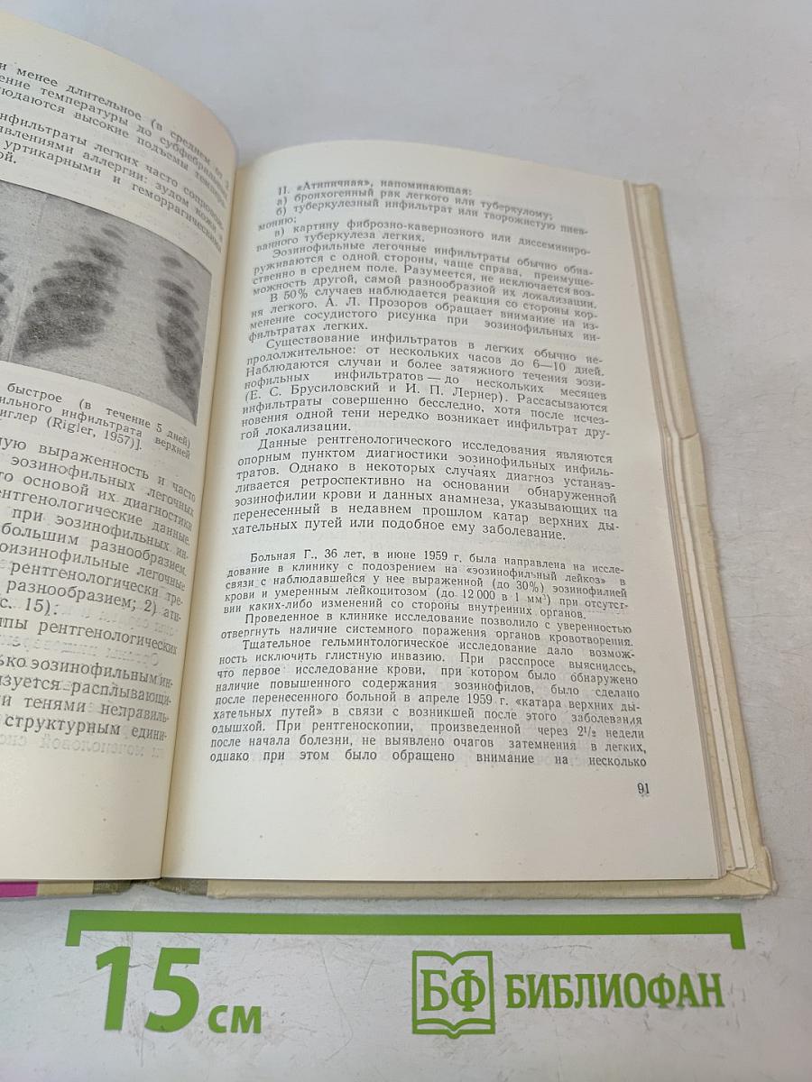 Большие эозинофилии крови и их клинико-диагностическое значение