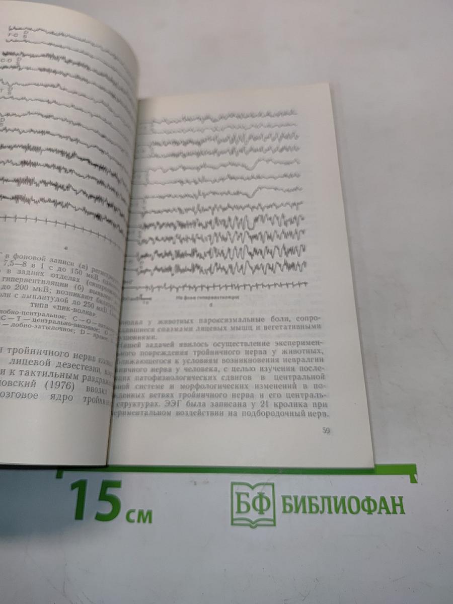 Невралгия тройничного нерва