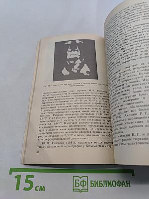 Диагностические и тактические ошибки при раке гортани