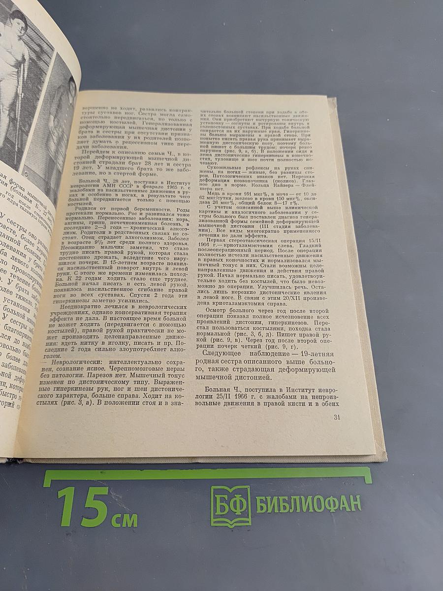 Деформирующая мышечная торсионная дистония (клиника и хирургическое лечение)