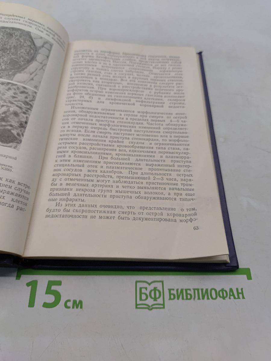 Патологическая анатомия коронарной недостаточности
