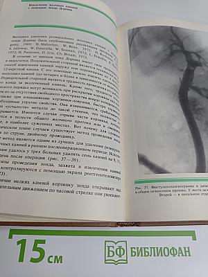 Бескровные методы удаления желчных камней