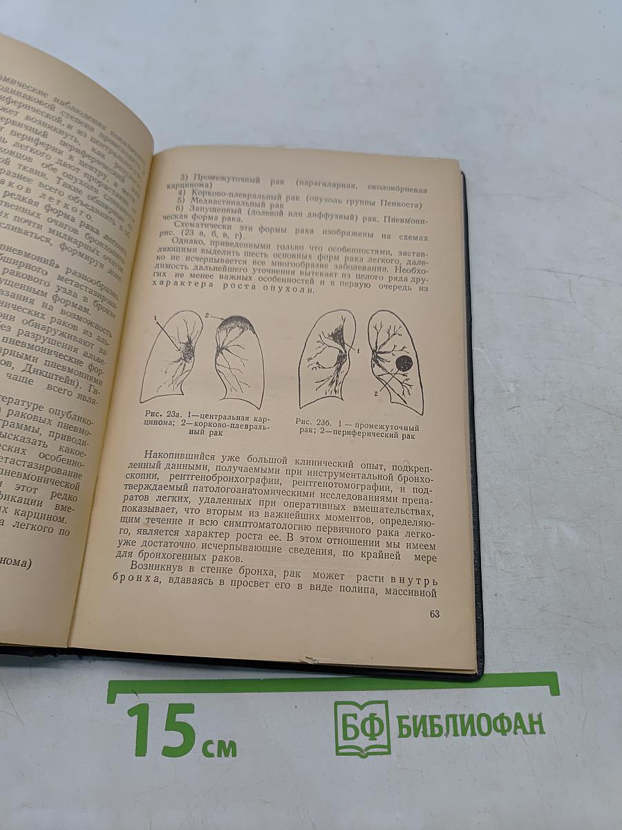 Рентгенодиагностика рака легкого