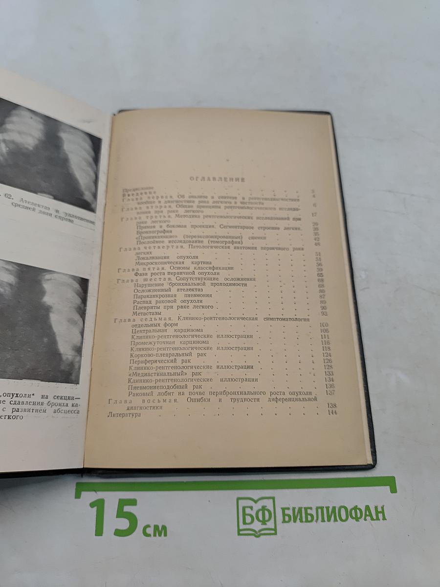 Рентгенодиагностика рака легкого