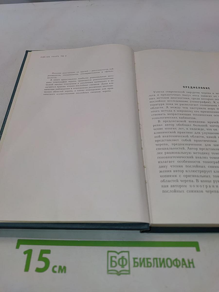 Томография черепа