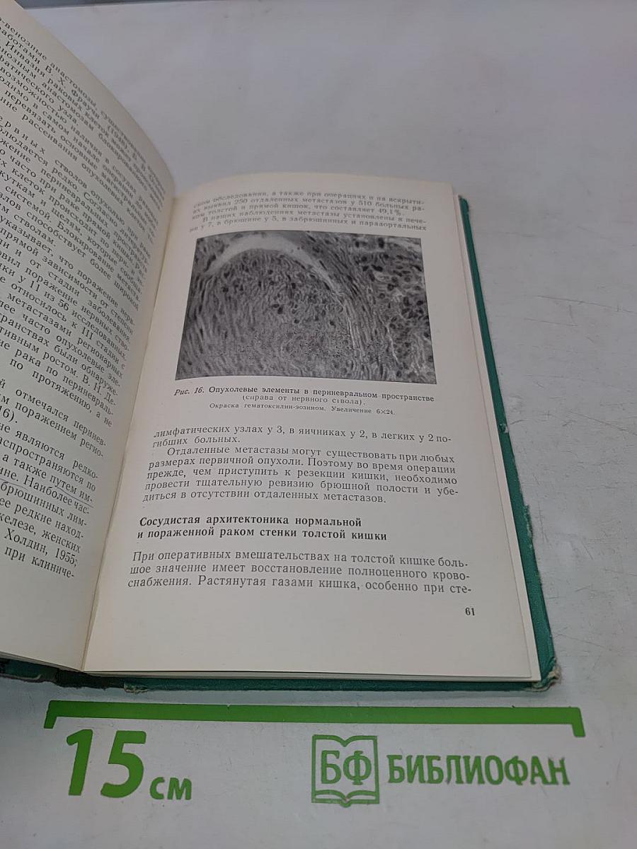 Рак толстой кишки