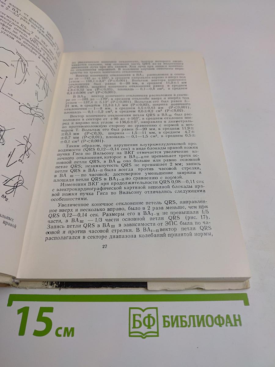 Изменения электро- и вектор-кардиограммы при гипертрофии миокарда