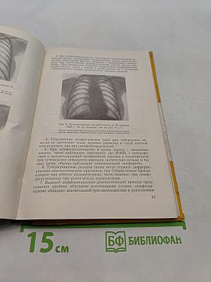 Дифференциальная диагностика туберкулеза легких