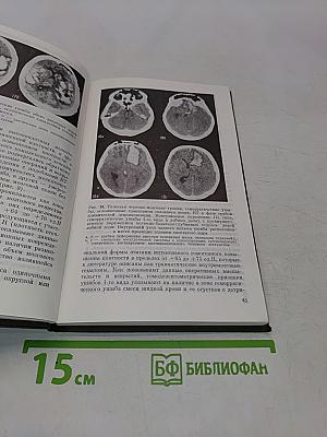 Компьютерная томография в диагностике черепно-мозговой травмы