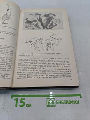 Стенокардия