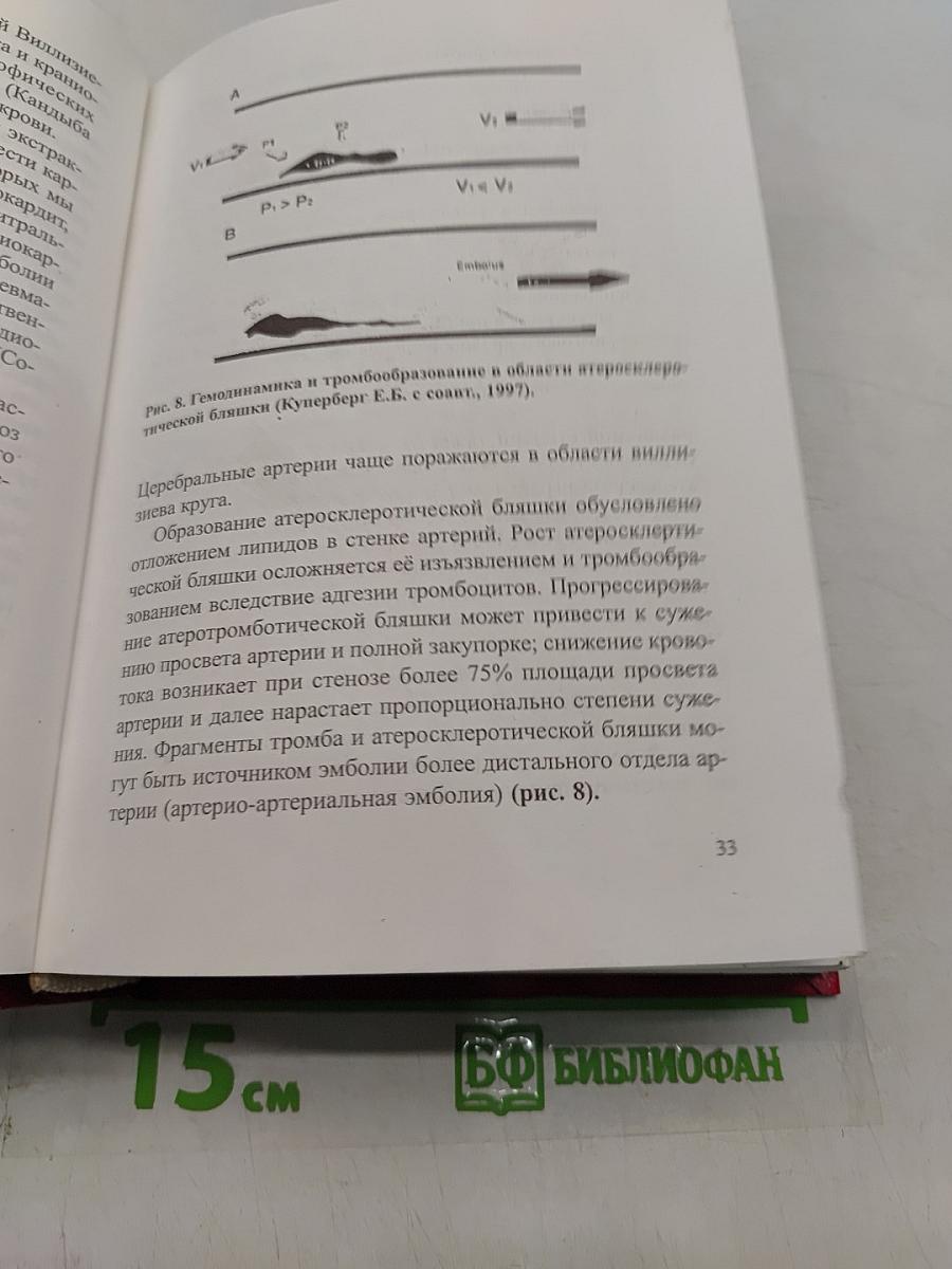 Нарушения мозгового кровообращения при патологии экстракраниальных артерий