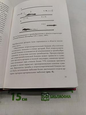 Нарушения мозгового кровообращения при патологии экстракраниальных артерий