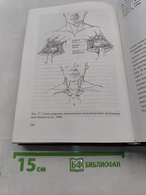 Нарушения мозгового кровообращения при патологии экстракраниальных артерий