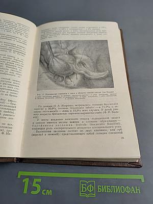 Острый аппендицит