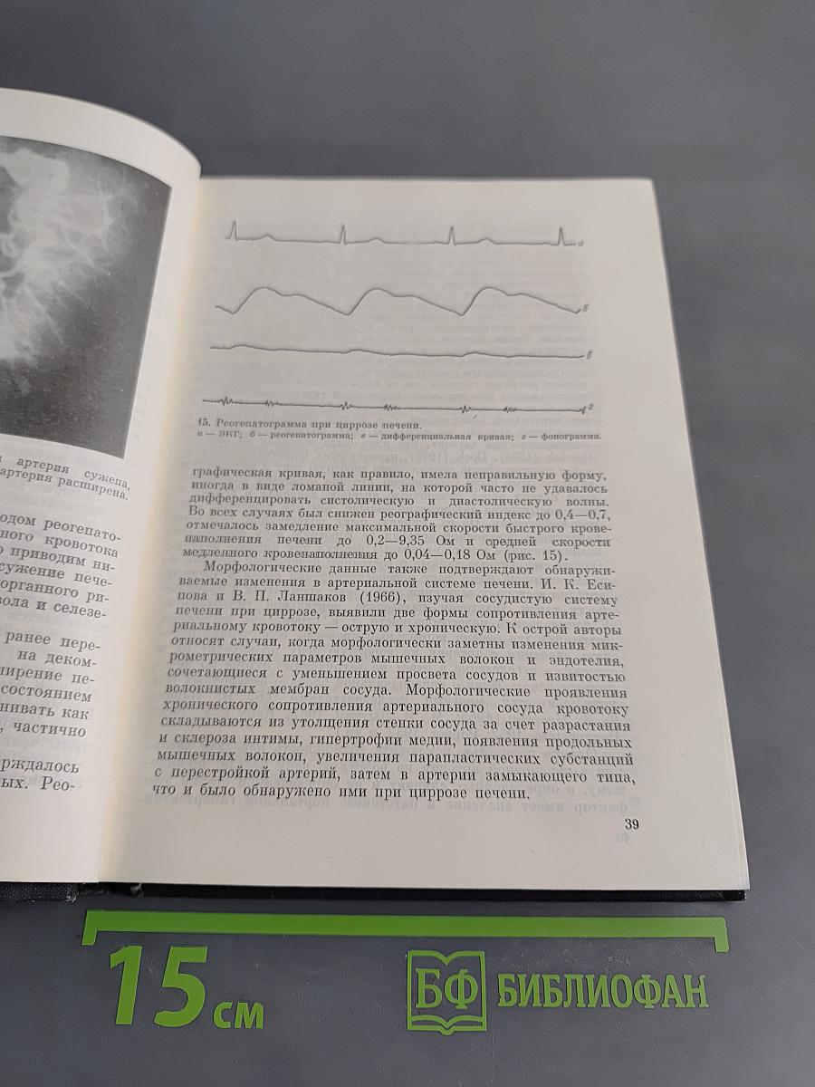 Хирургия портальной гипертензии