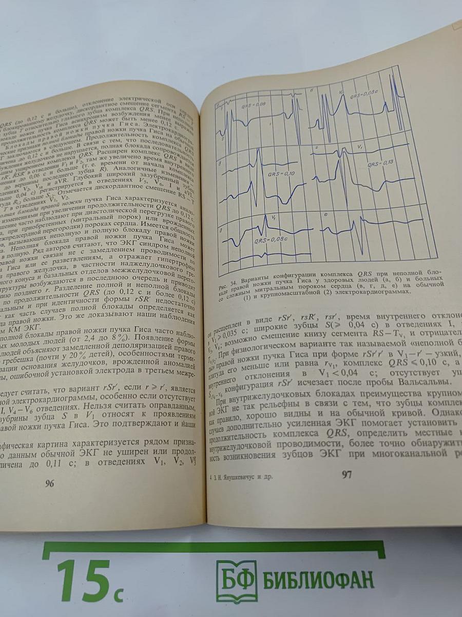 Дополнительно усиленная электрокардиограмма