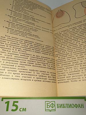 Искусственная вентиляция легких в интенсивной терапии