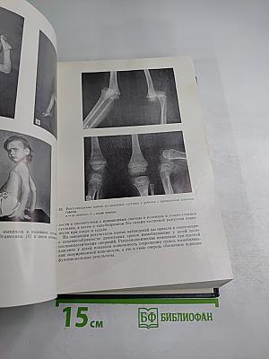 Болезни костей у детей