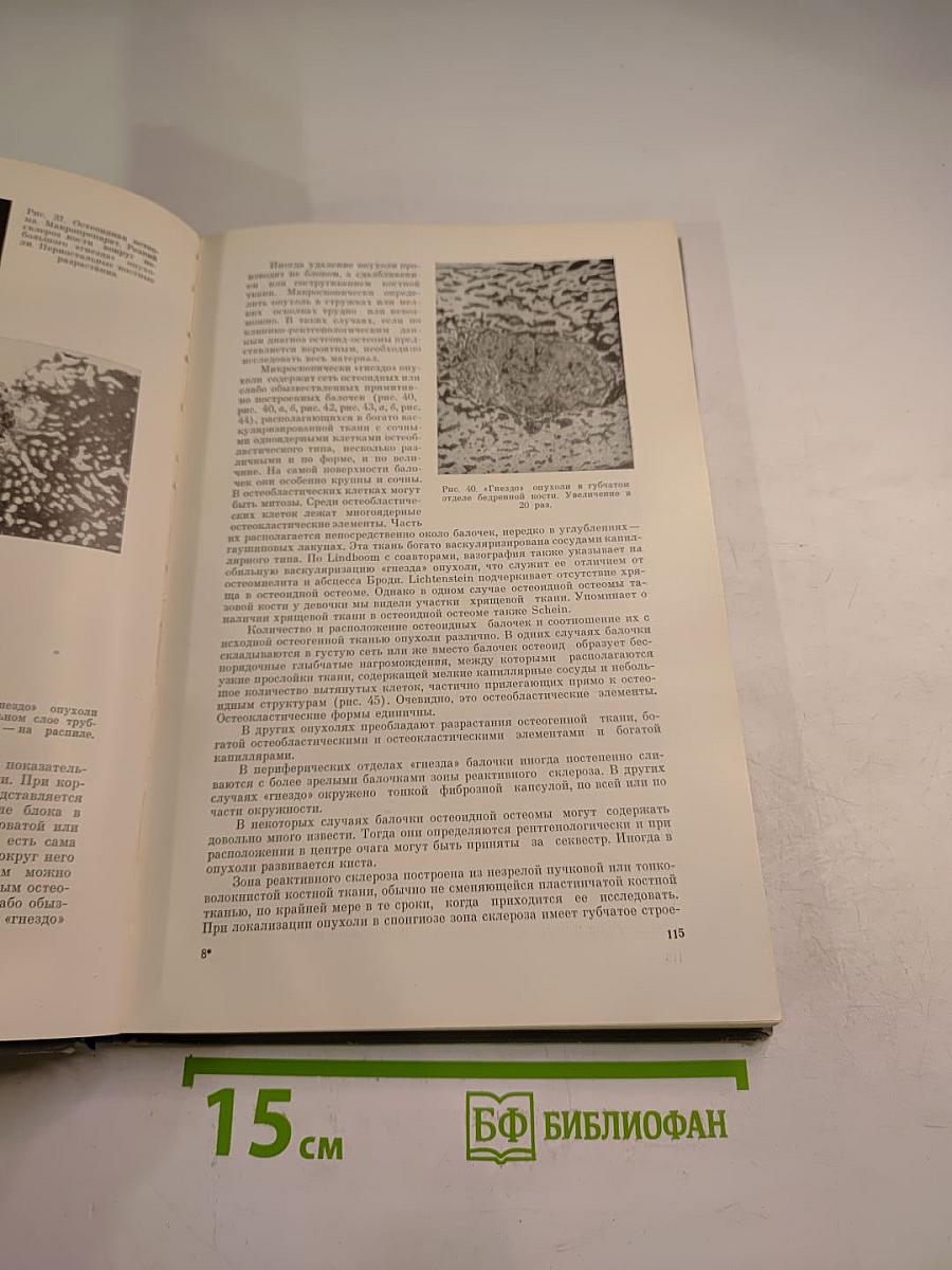 Опухоли костей