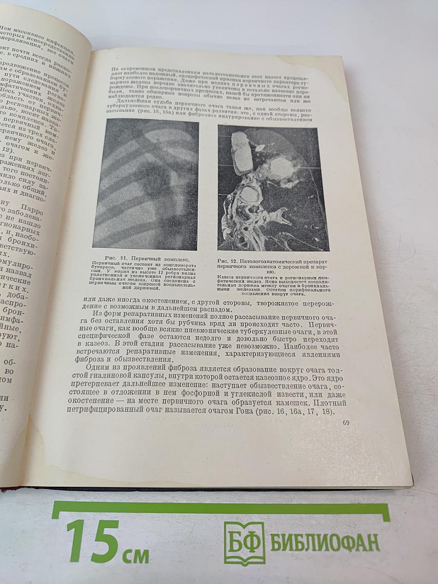 Туберкулез легких. Пособие для студентов и врачей