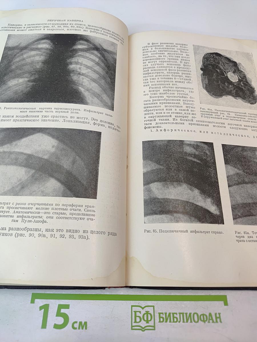 Туберкулез легких. Пособие для студентов и врачей