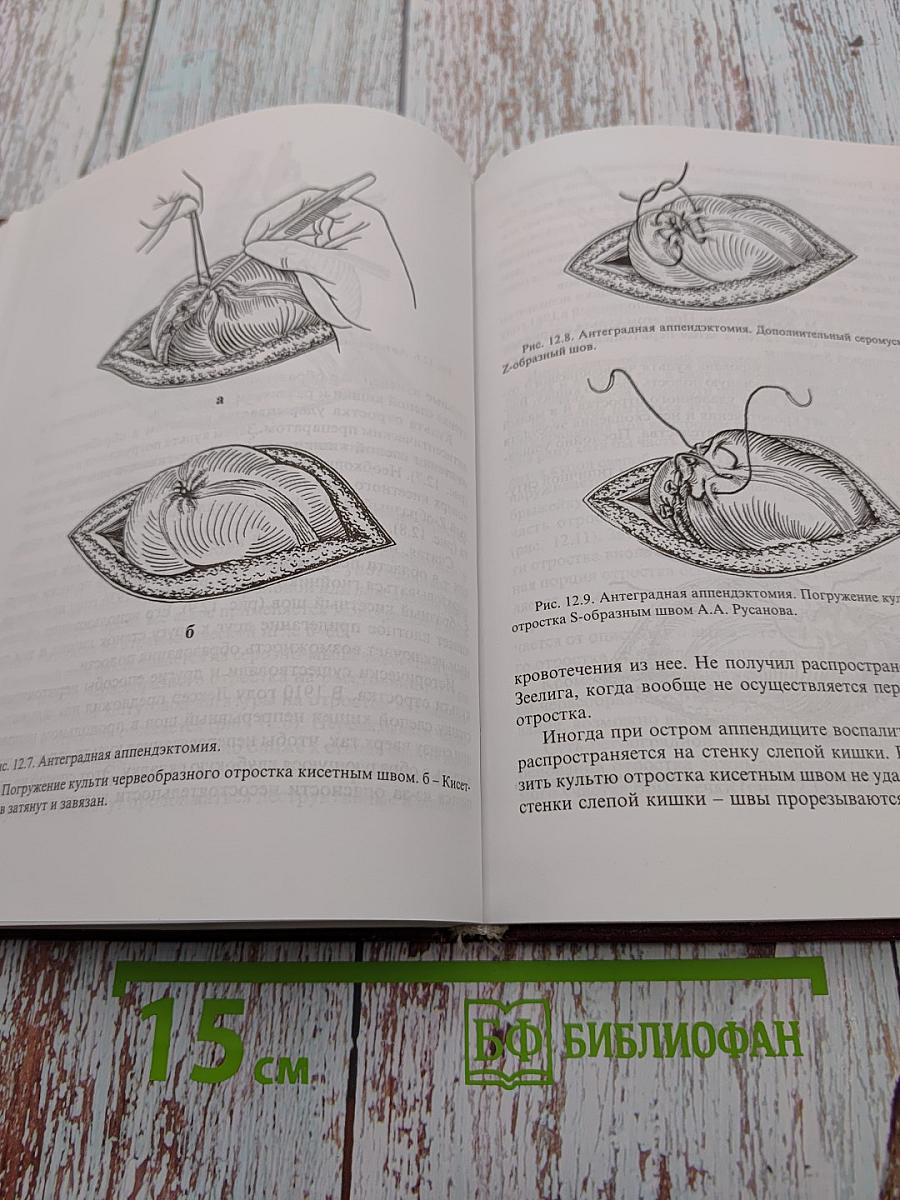 Аппендицит