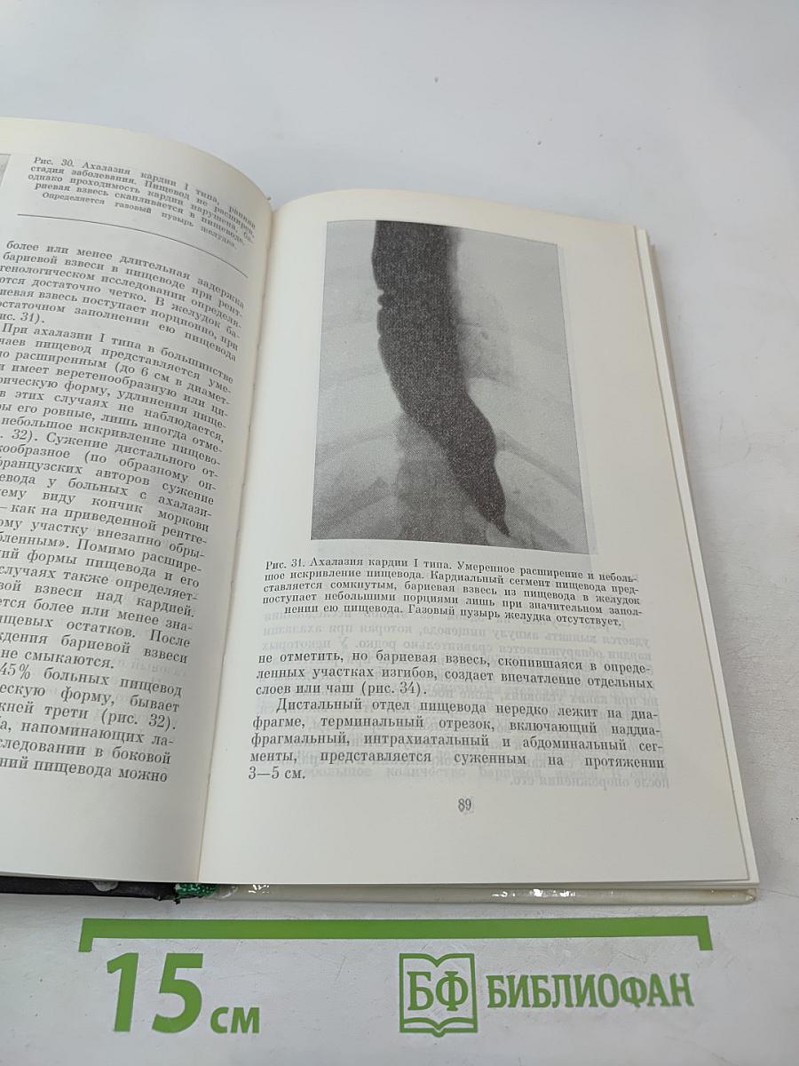 Ахалазия кардии