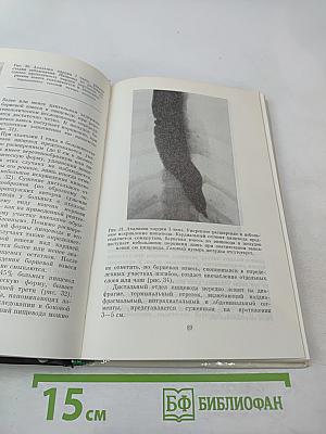 Ахалазия кардии